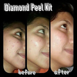 PROMO Diamond Peel Facial Kit