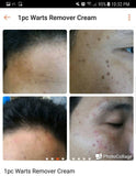 Jailev's Warts Remover Cream 100g (Mild)